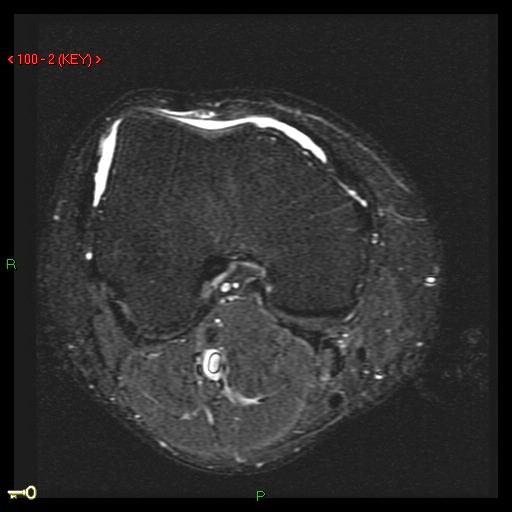 Figure 5 for case Patellar tendon re-tear